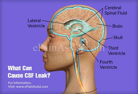 thin yellow fluid leaking from nose|How Do You Know If You Have Cerebrospinal Fluid。